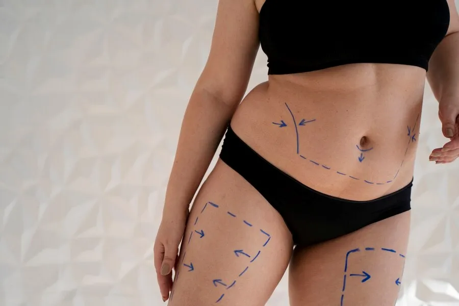 Imagem ilustrativa de Abdominoplastia no Piauí