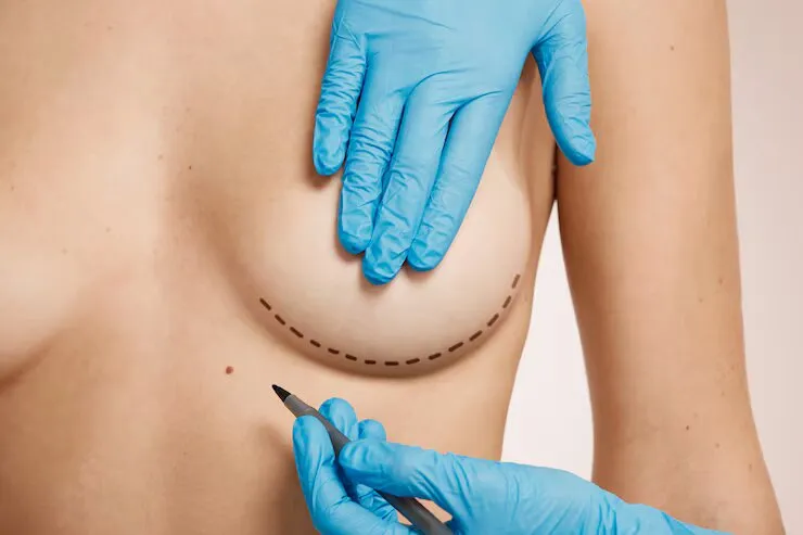 Mamoplastia redutora valor